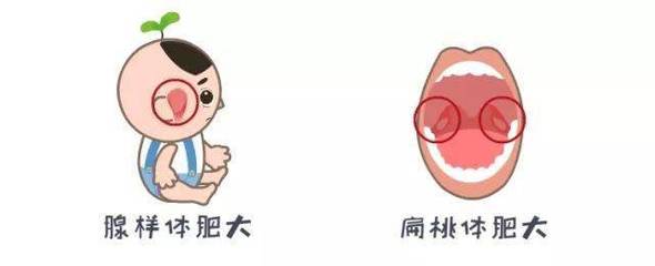 宝宝腺体肥大