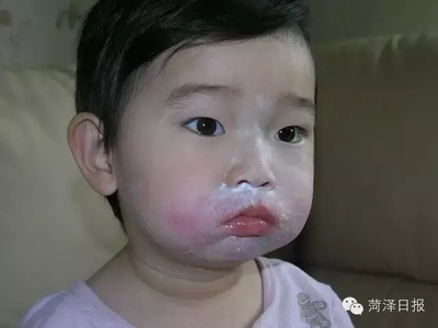 宝宝吃猕猴桃过敏症状