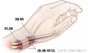 腱鞘积液是怎么回事