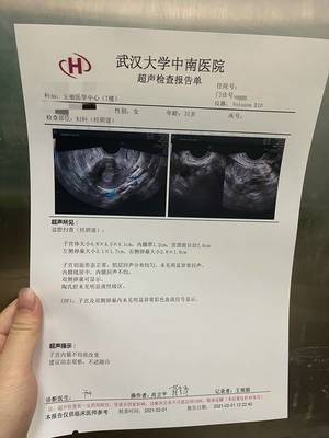 怀孕3个月孕囊多大