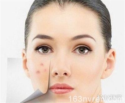 如何去痘痘的方法