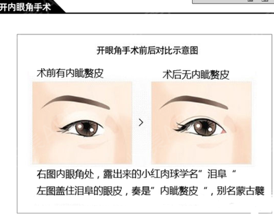 内眦赘皮双眼皮