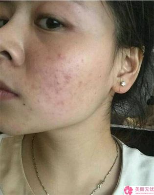 青春痘疤痕修复