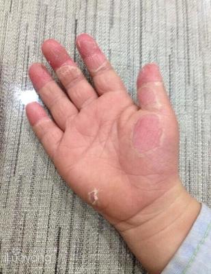 小孩手蜕皮是怎么回事