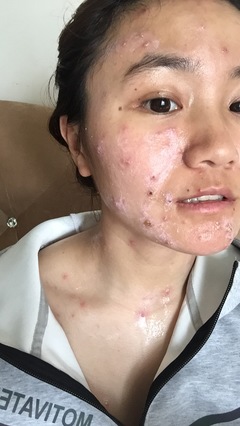 痘痘结痂凹陷