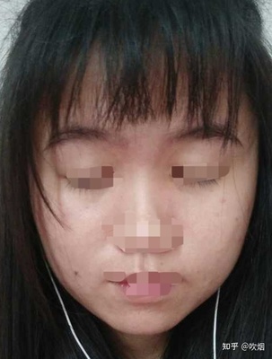 长痘痘变好的帖子
