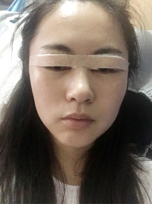 镇江割双眼皮