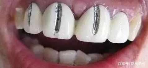 钴铬合金烤瓷牙做核磁共振可以吗