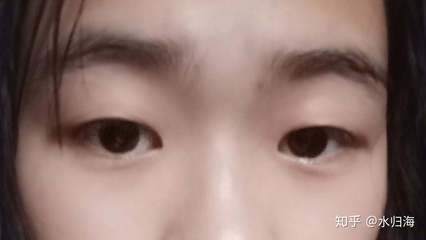 割双眼皮变窄