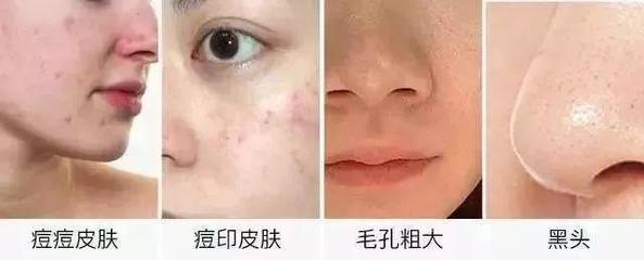 有痘痘痘印的怎么化妆