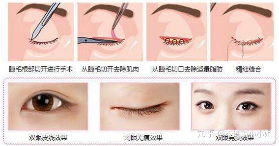 点式双眼皮