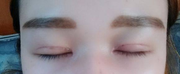 割了双眼皮多久可以碰水