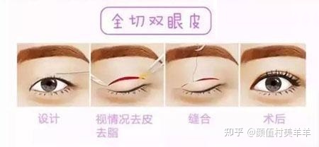 割双眼皮在哪里