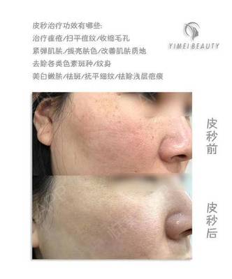 皮秒有痘痘可以做吗