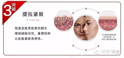 射频除皱
