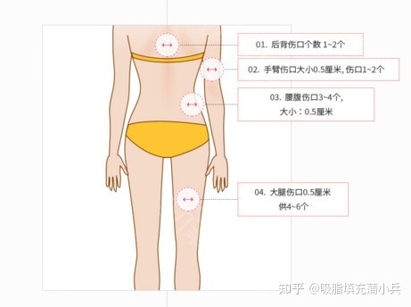 抽脂的危害