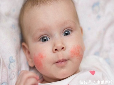 宝宝有湿疹怎么办