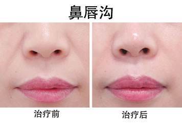 玻尿酸鼻唇沟多少钱