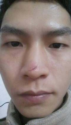 鼻子上有疤痕怎么办
