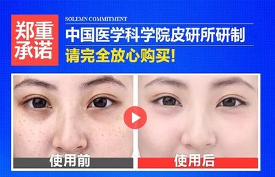 医学祛斑