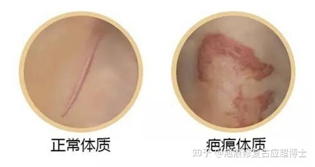 怎么判断自己是疤痕体质