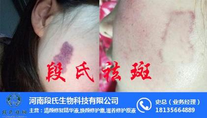洛阳祛斑