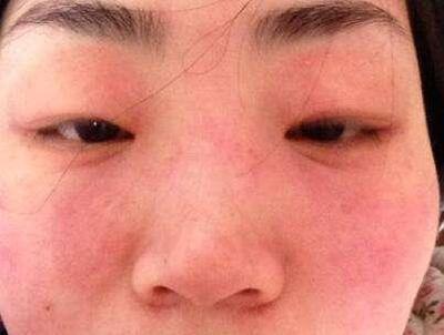 长了些小小的痘痘