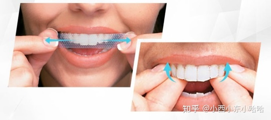 洗牙没有抛光
