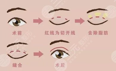 新乡割双眼皮哪里好
