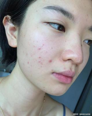 痘痘泛红是怎麽回事