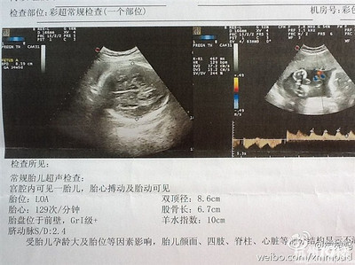 孕妇32周做什么检查