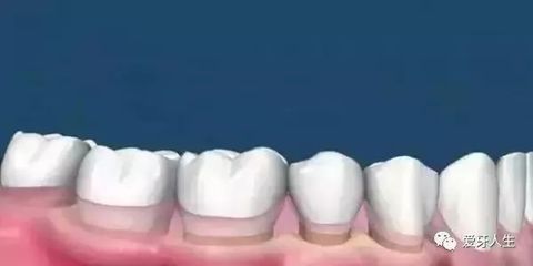 洗牙没有抛光
