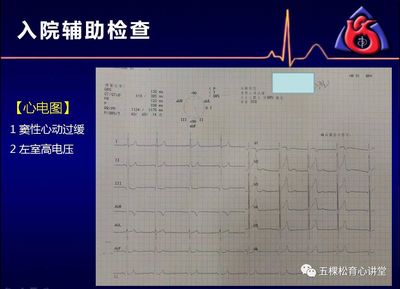 左室高电压是怎么回事