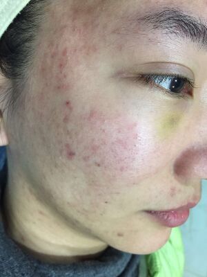 治脸上痘痘的中药