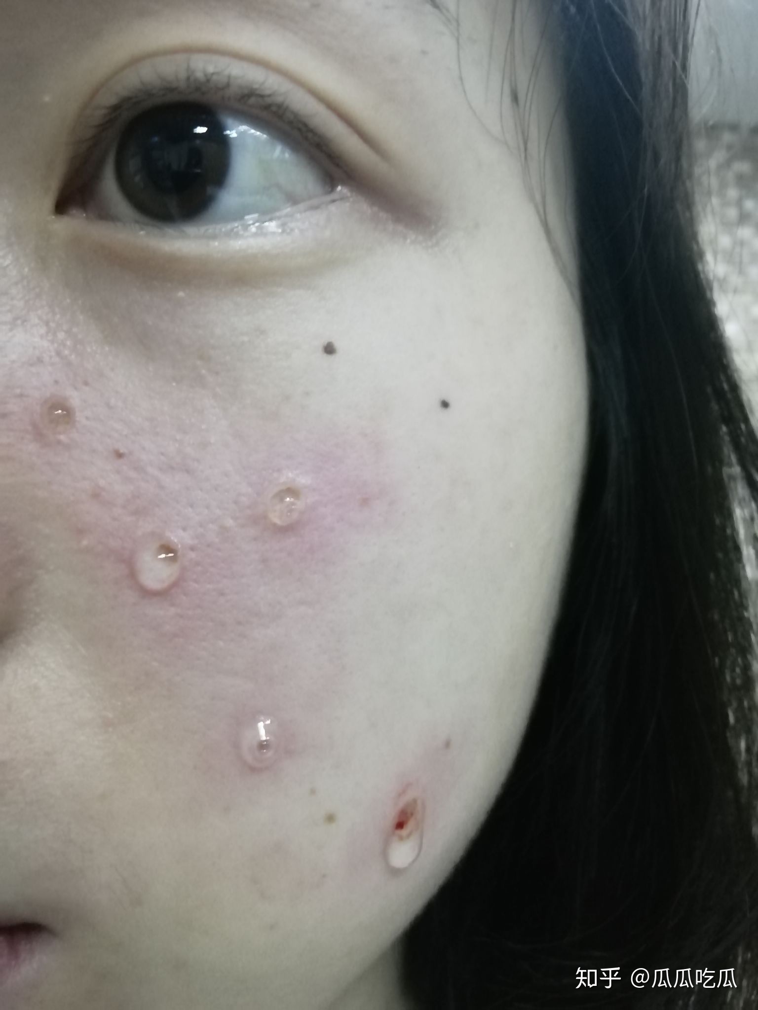 可以祛痣吗