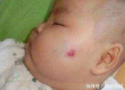 胎儿胎记是什么造成的