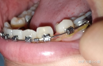 拔牙后多久恢复正常