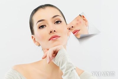 去除痘痘好方法