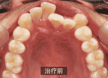 牙齿是歪的如何校正