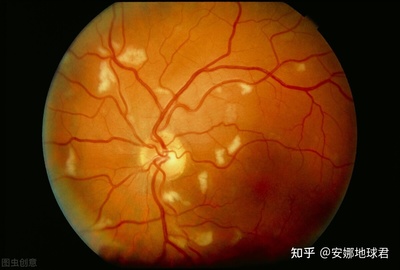 眼真菌感染怎么治疗