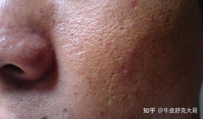 男生脸部毛孔粗大怎么办