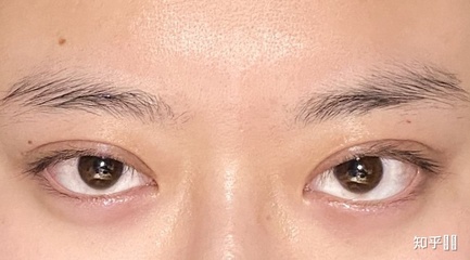 潍坊双眼皮