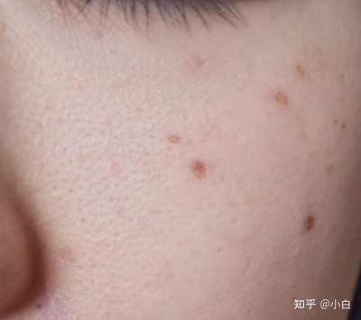 多大的痣可以用激光点