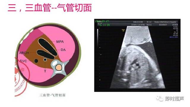 胎儿心脏检查