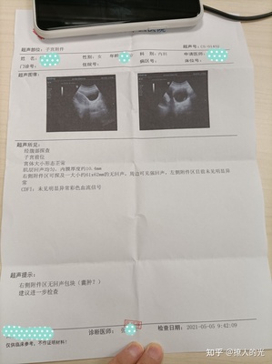 排卵期囊肿