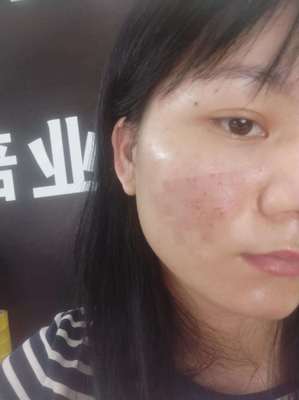 激光治痘痘后遗症