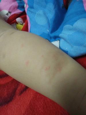 背上的痘痘是啥