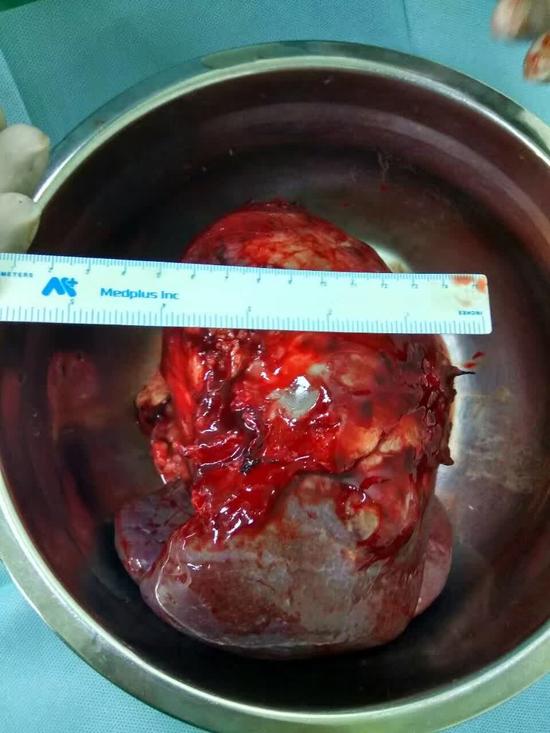 胆囊可以完全切除吗?胆囊可以随便切除吗?