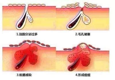 怎么去除囊肿型痘痘