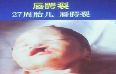 引产胎儿是活的吗